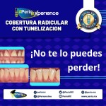 Cobertura Radicular Con Tunelización $USD